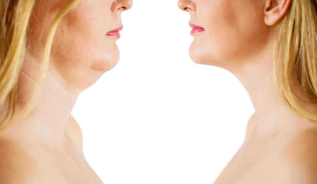 Double Chin treatment Rickmansworth before and after results