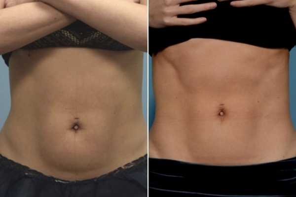 body sculpting FAQs Rickmansworth