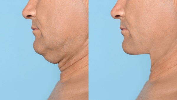 Which Non-Surgical Treatments Work Best for Jowls and Loose Skin Rickmansworth?