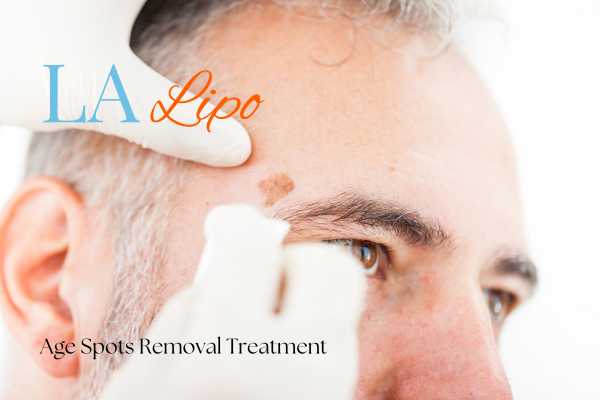 What Are the Most Effective Treatments for Age Spots Rickmansworth?