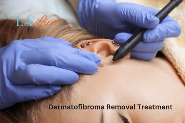 Dermatofibroma Removal Treatment Rickmansworth