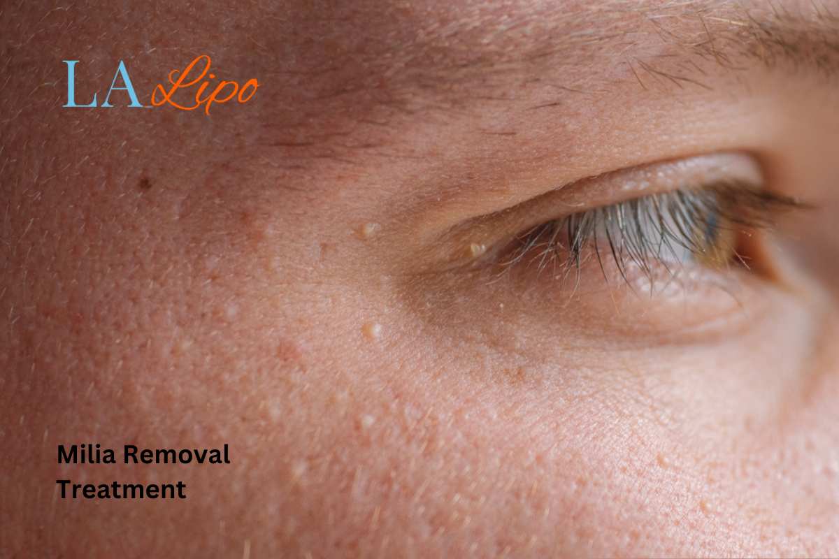 Cryopen Milia Removal: Is It the Easiest and Safest Option Rickmansworth?
