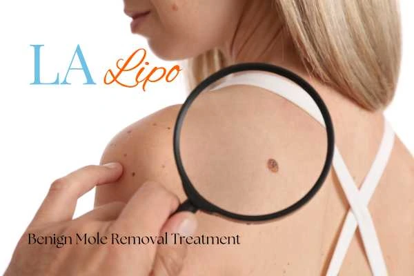 Why getting moles removed Rickmansworth can boost your confidence!