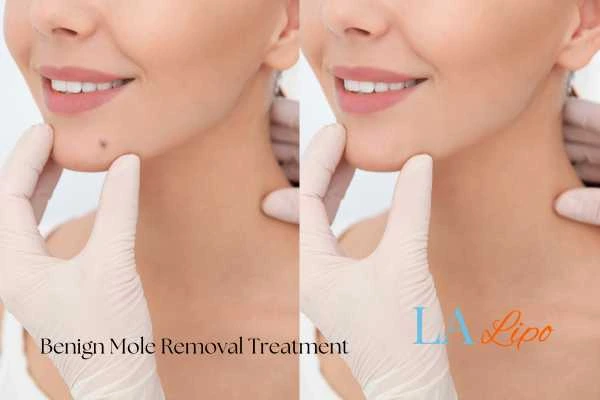 woman's before and after mole removal Rickmansworth results