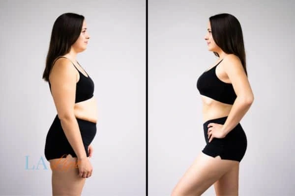 image of woman before and after results of LA-EMS Body Sculpting Rickmansworth to help treat Diastasis recti