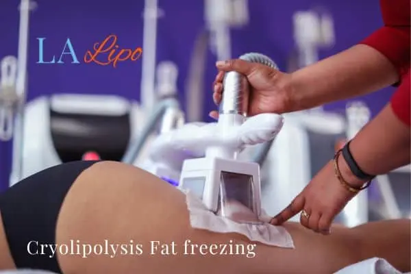 women getting fat freezing Rickmansworth
