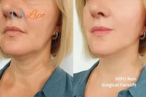 hi-fu for wrinkles Rickmansworth before and after results