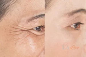 Before and after results of woman - HI-fu wrinkles reduction treatment Rickmansworth
