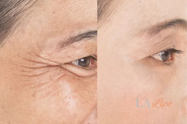 Before and after results of woman - HI-fu wrinkles reduction treatment Rickmansworth