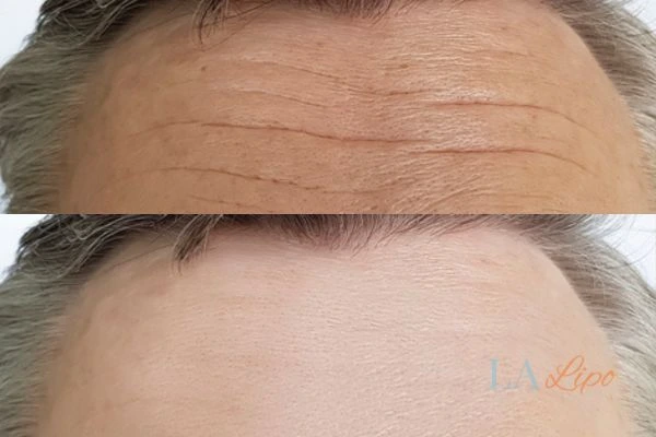 results of HIFU Rickmansworth on mans forehead to help reduce lines and wrinkles