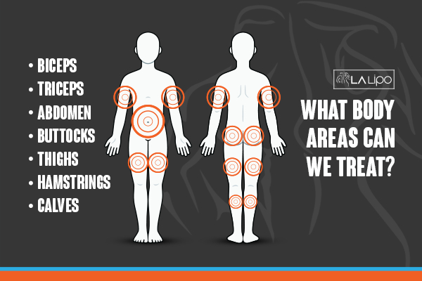 Graphic to show areas you can have LA-EMS Body Sculpting Rickmansworth treatment.