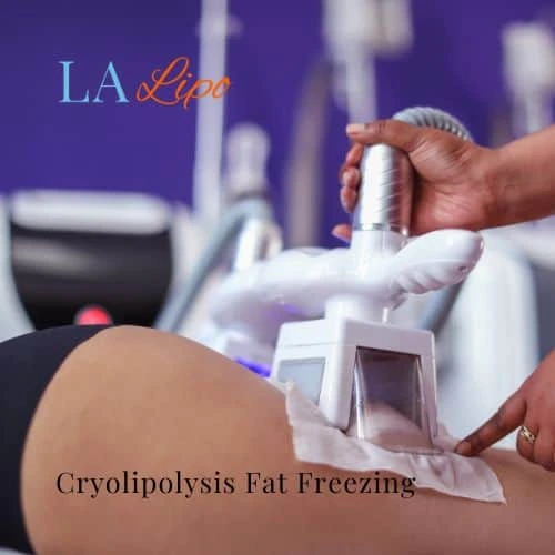 fat freezing - Cryolipolysis Rickmansworth