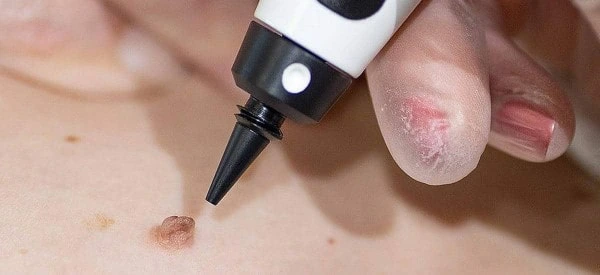 skin tag removal using cryopen Rickmansworth
