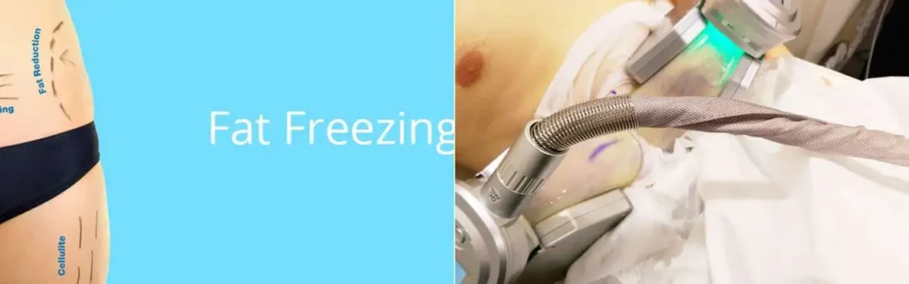 Fat freezing Rickmansworth on multiple areas of the body