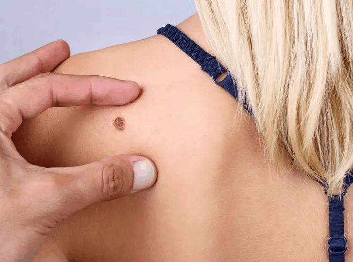 woman having mole removal Rickmansworth consultation before treatment.