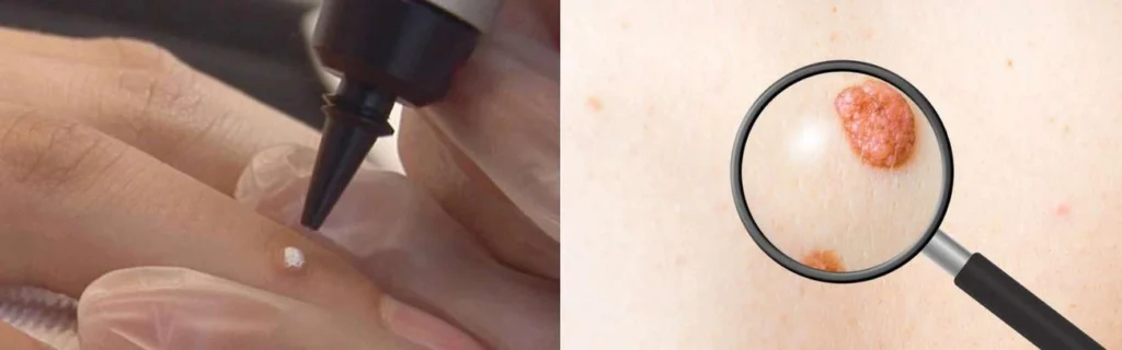 Person getting moles removed with cryopen Rickmansworth