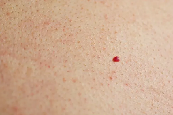 close up of a cherry angioma Rickmansworth