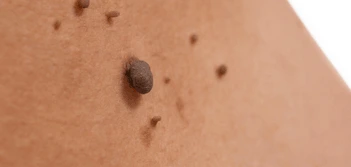 image of a skin tag Rickmansworth