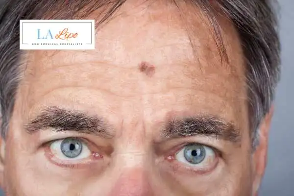 Solar Lentigo Removal Rickmansworth image of man with mark on his forehead