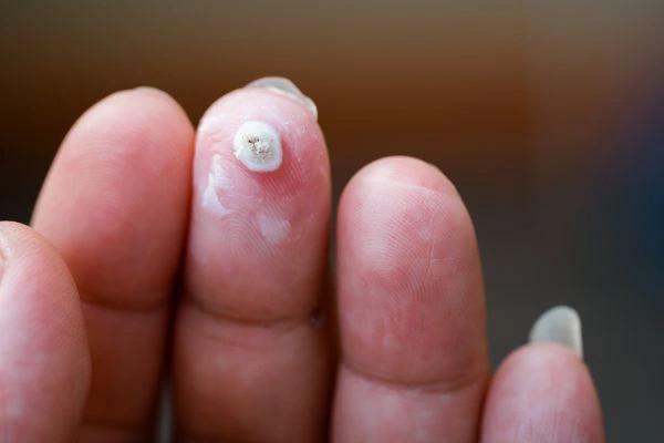 wart on person finger - cryotherapy to treat from LA LIPO Rickmansworth