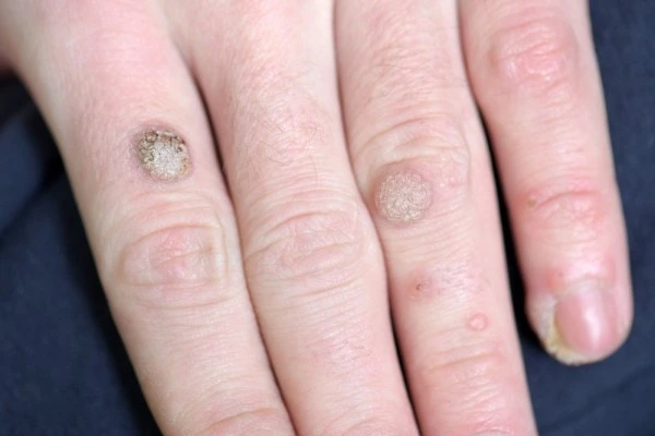 photo of warts on person hand - see wart removal Rickmansworth from LA LIPO