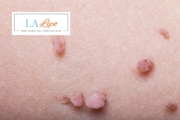Does cryopen skin tag removal Rickmansworth hurt? Find out now call our team today!