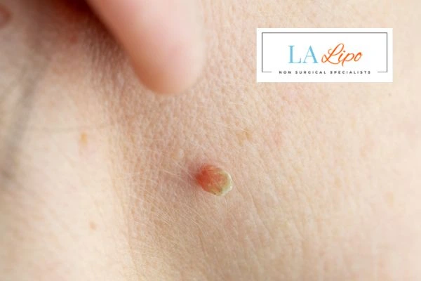 Book skin tag removal Rickmansworth today speak to our team now!