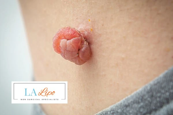 Interested in skin tag removal Rickmansworth? Concerned about the pain? Find out more today!