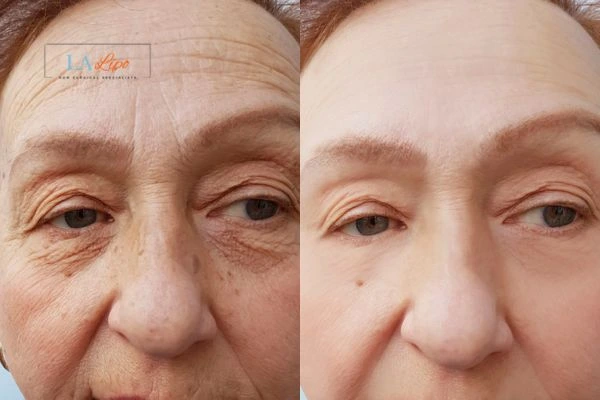 The powerful benefits of Morpheus8 Treatment Rickmansworth - Call Our team today!