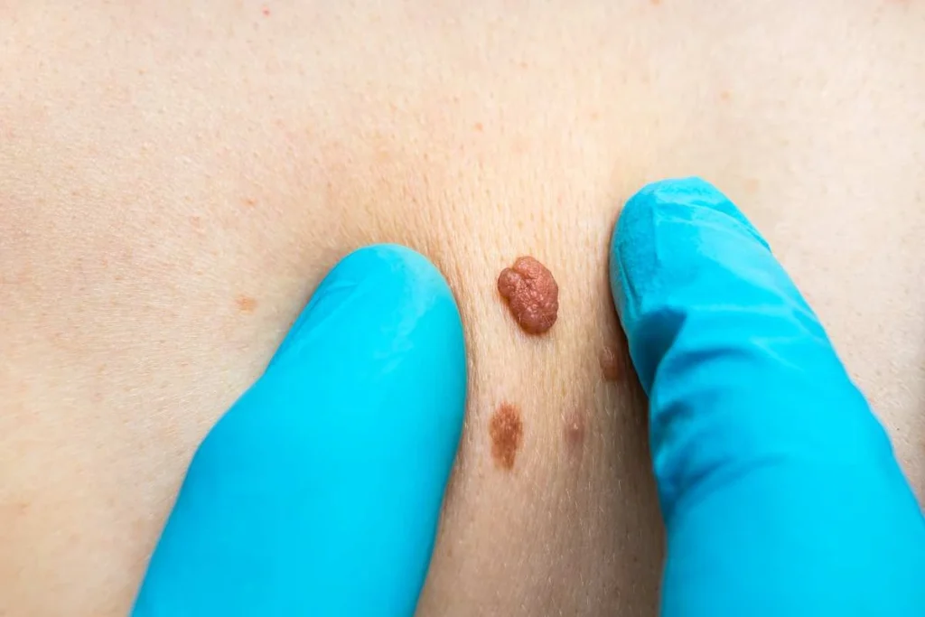 LA LIPO Cryopen Lesion Removal Prices Rickmansworth