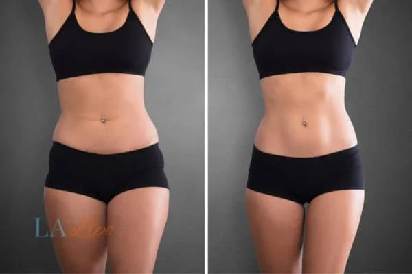 before and after results of non-surgical treatment to help a woman's body image and mental health Rickmansworth