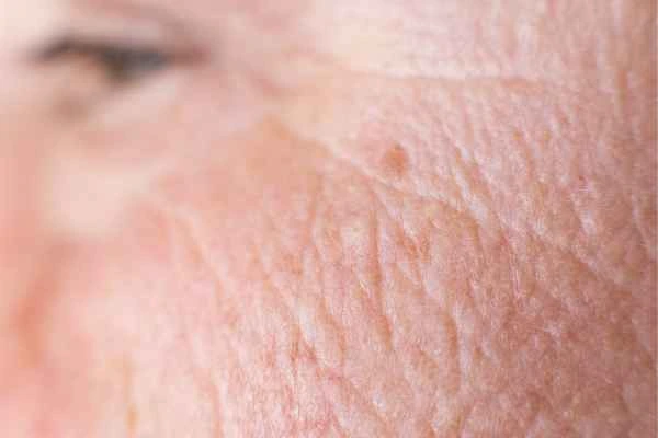 close up picture of a woman's face showing an age spot Rickmansworth