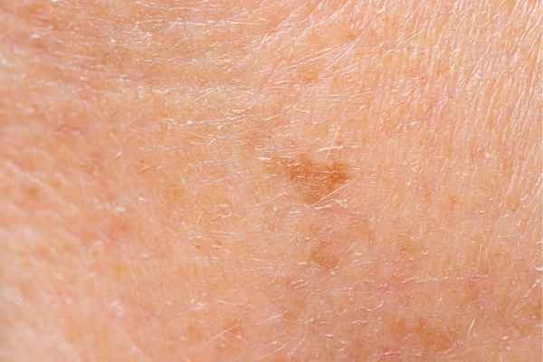 close up picture of age spots Rickmansworth
