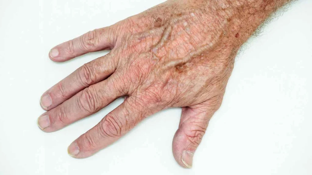 Male hand showing age spot Rickmansworth