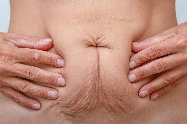 Image of a woman's stomach with loose skin - example of skin tightening Rickmansworth options
