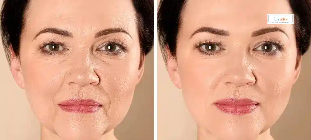 How Long Does It Take to See Results and How Long Do They Last Rickmansworth?
