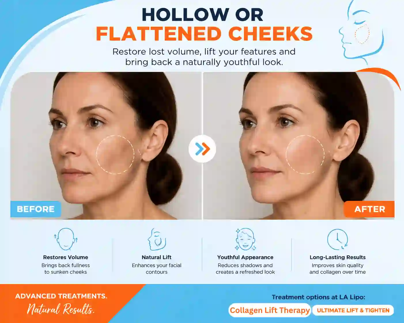 Sign #4: Hollow or Flattened Cheeks Rickmansworth