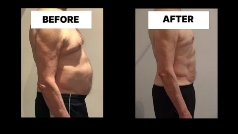 What Symptoms Can Diastasis Recti Cause in Men? Weak Core, Back Pain and Poor Posture Rickmansworth